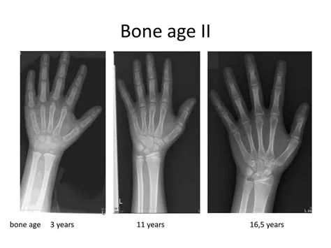 Is bone appropriate for 12 year olds